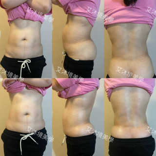 【票券】腹直肌修復