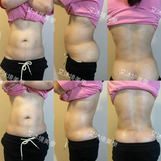 【票券】腹直肌修復